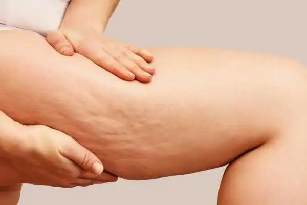 Image of woman showing leg with cellulite Almondsbury