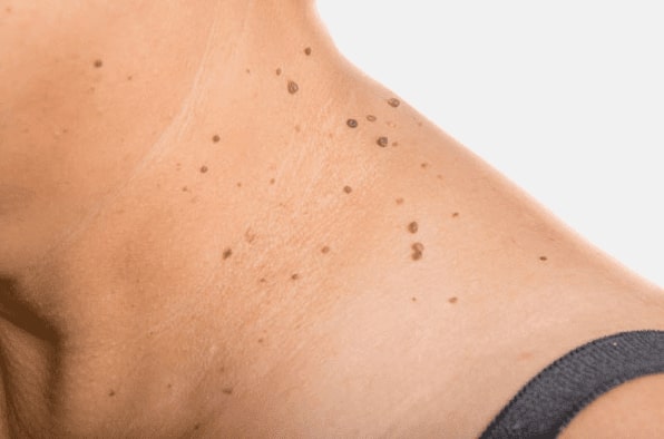 Are you looking for easy skin tag removal Almondsbury - then contact Spire today!