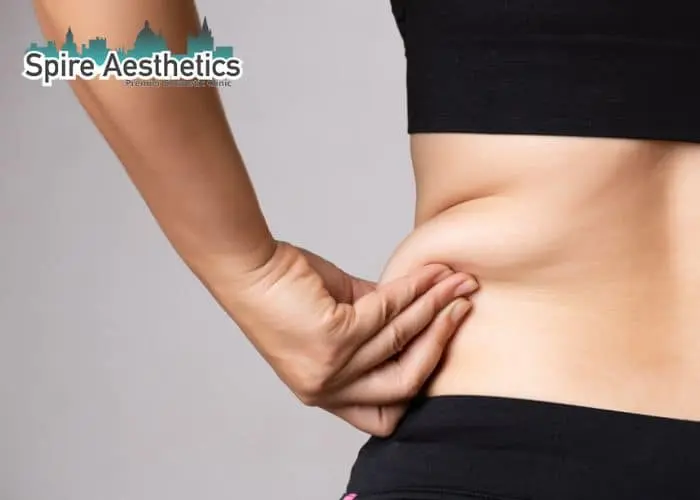 Image of woman pinching fat on their hips Almondsbury. Fat Freezing treatment