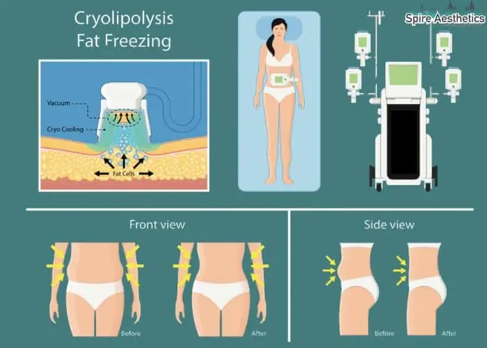 Fat freezing treatment Almondsbury benefits for competitions to remove stubborn fat deposits.