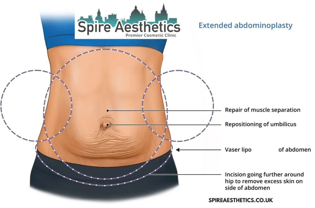 Understanding Loose Skin After Gastric Band Almondsbury Surgery and HIFU Treatment