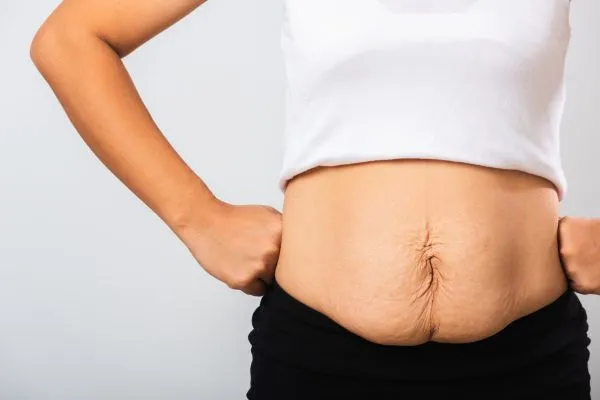 Image of a woman's stomach after weight loss with sagging skin following a gastric band Almondsbury