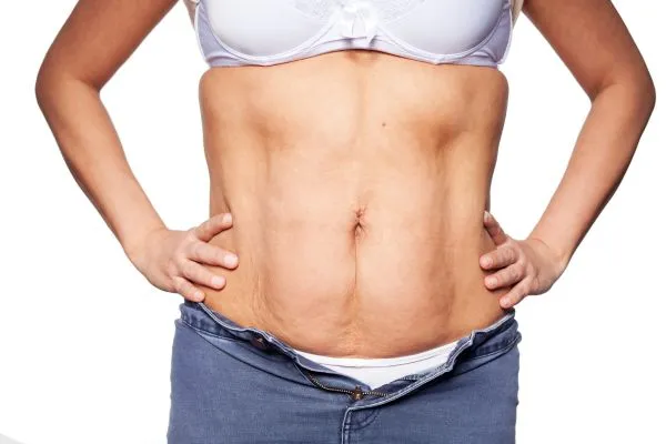 sagging skin on woman's stomach after weight loss injections Almondsbury