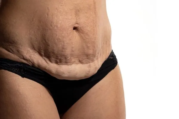 Image of womans stomach after weight loss injections Almondsbury showing saggy skin